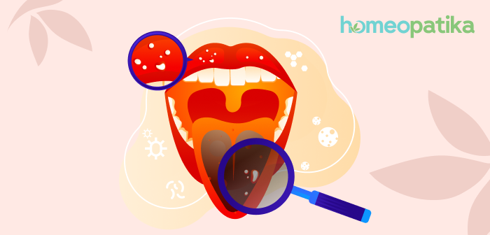  afty v dutině ústní