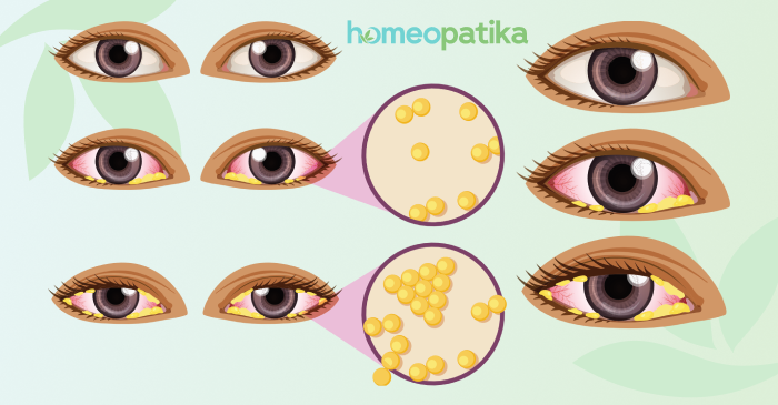  alergie a zánět spojivek