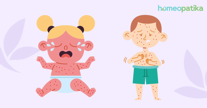  děti trpící neštovicemi