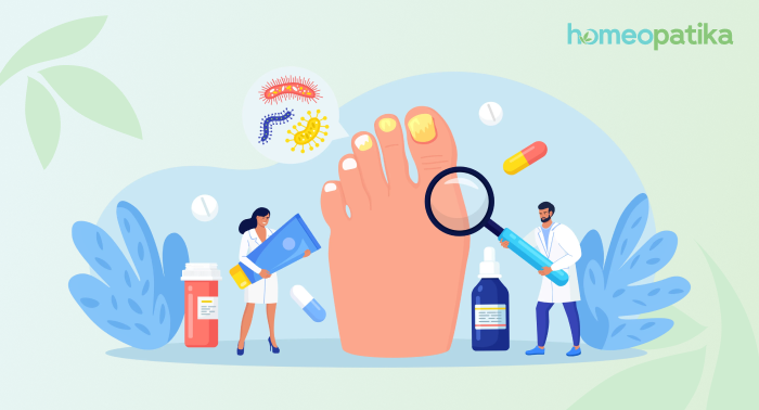  léčebný proces molusek a bradavic