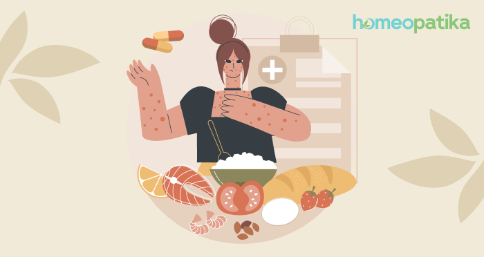  homeopatická léčba na kopřivku