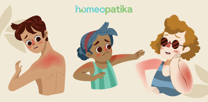  homeopatika na sluneční alergii