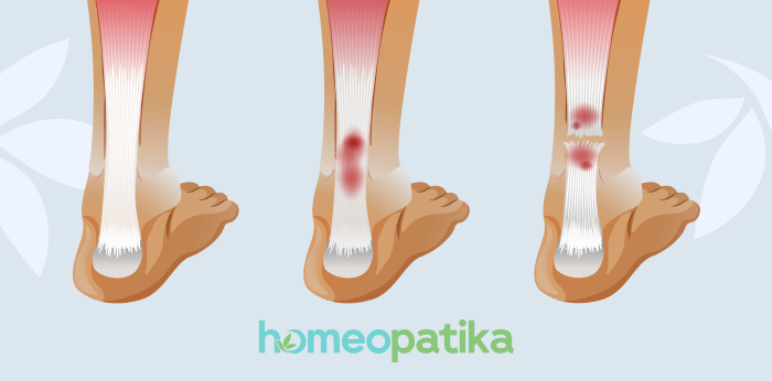 homeopatika na zánět šlach