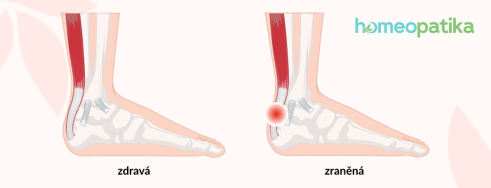 příznaky zánětu šlach