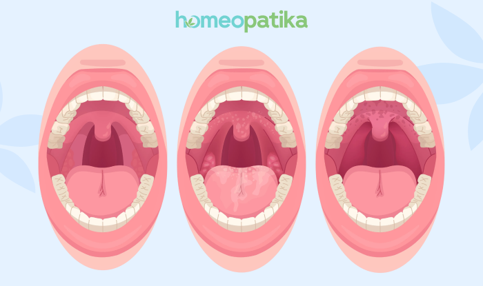  zdravé a zanícené mandle