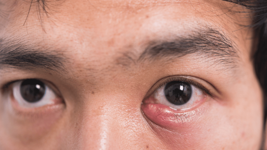 Ječné zrno v koutku oka.