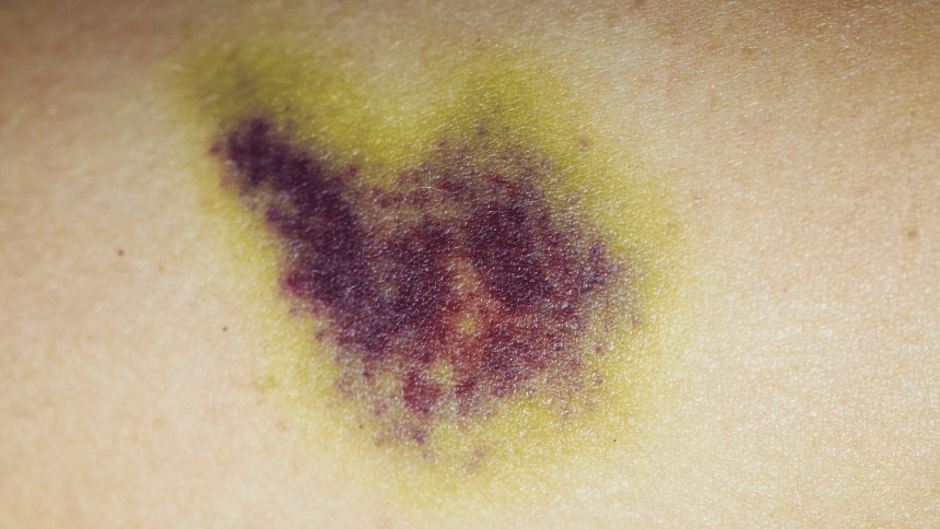 Modřina hrající mnoha barvami.