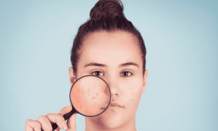 Slečna zvětšující lupou akné.