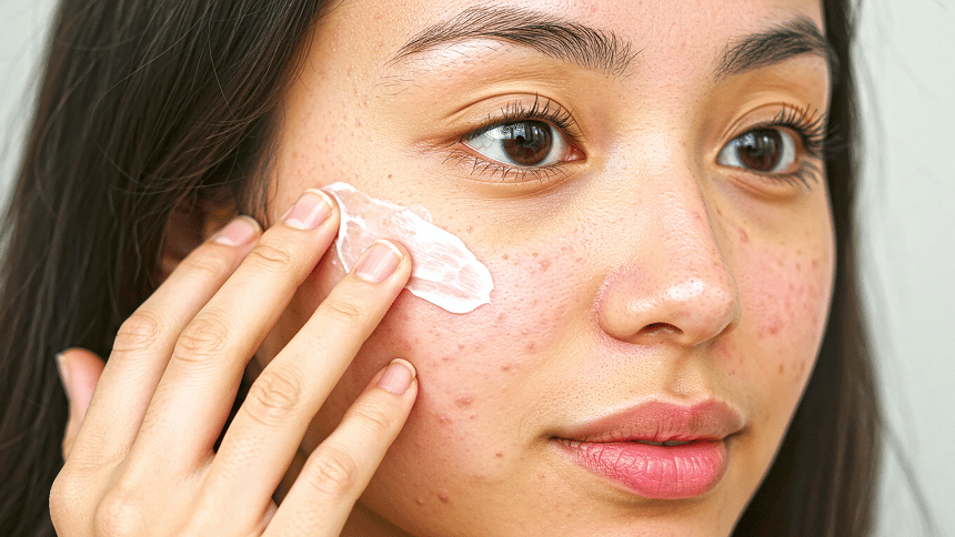 Střední akné ošetřovné krémem.