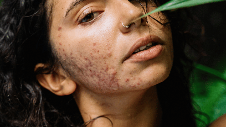 Silné hormonální akné.