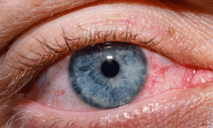 Začervenalé oko vinnou alergie.