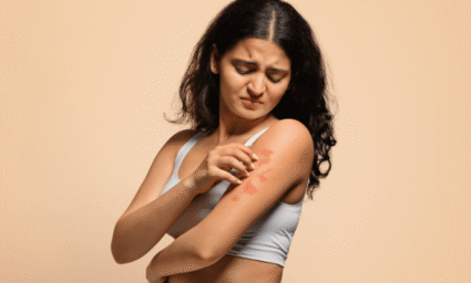 Dívka s podrážděnou pokožkou od UV paprsků.