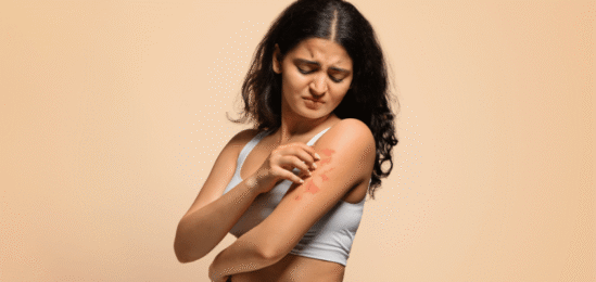 Dívka s podrážděnou pokožkou od UV paprsků.