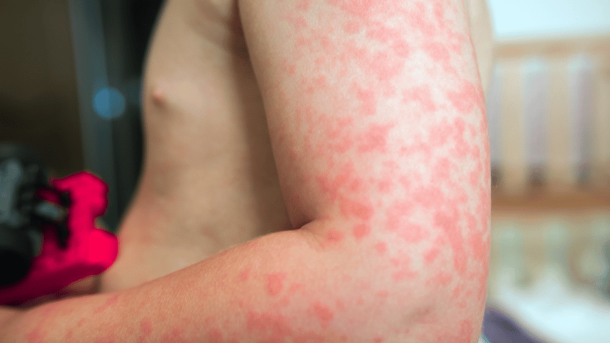 Ruka plná puchýřů od sluneční alergie.