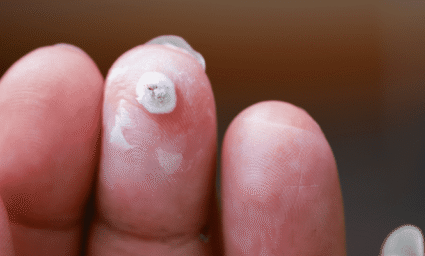 Bradavice na prstech.