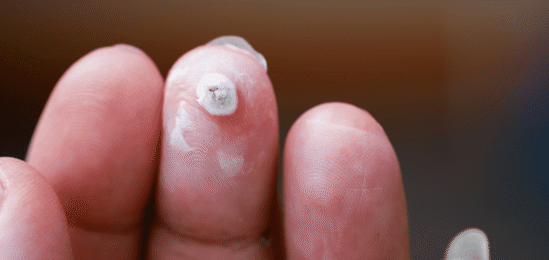 Bradavice na prstech.