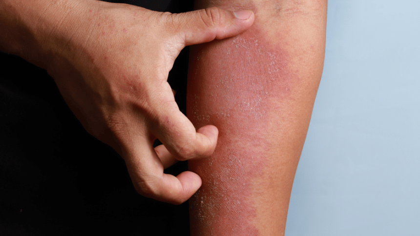 Kontaktní a svědivý ekzém na ruce.