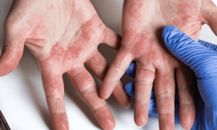 Ekzém rozšířený po dlaních.