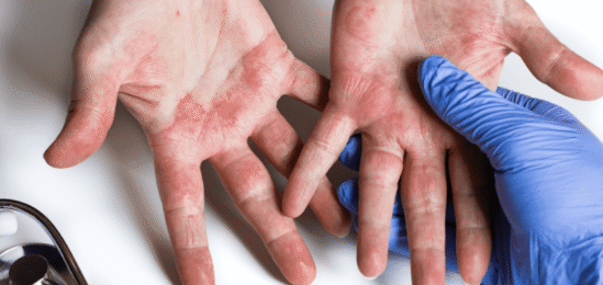 Ekzém rozšířený po dlaních.