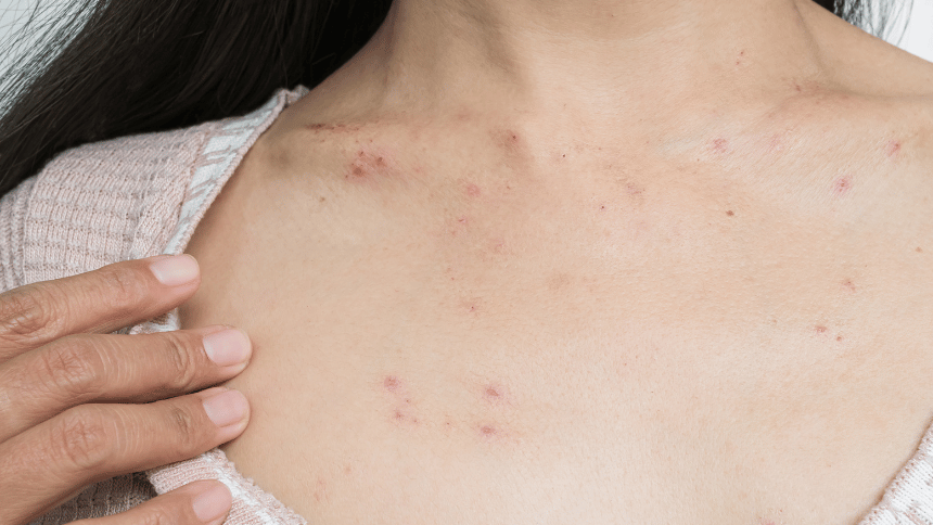 Kopřivka, která se rozšířila až na hrudník.