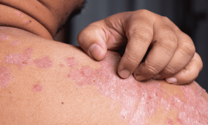 Muž škrábající si lupénku na rameni.