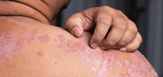 Muž škrábající si lupénku na rameni.