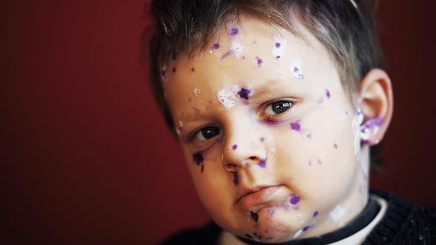 Dítě pomazané krémem proti svědění.