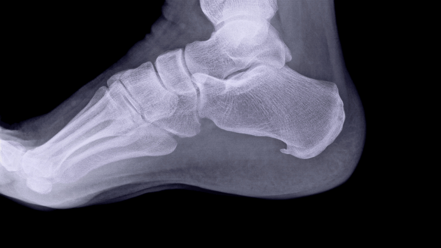 Patní ostruha viditelná na rentgenu.