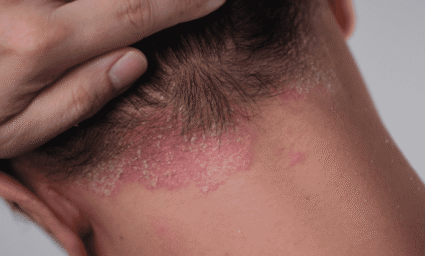 Seborea na přechodu kůže a vlasů.