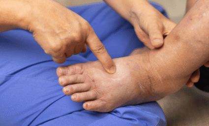 Otok nohy léčený doktorem.