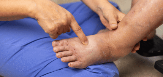 Otok nohy léčený doktorem.