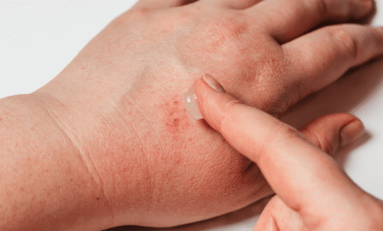 Infekce rozšířená na ruce.