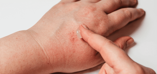 Infekce rozšířená na ruce.