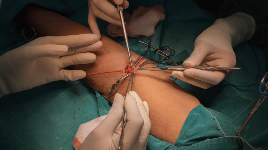 chirurgické  odstranění píštěle.