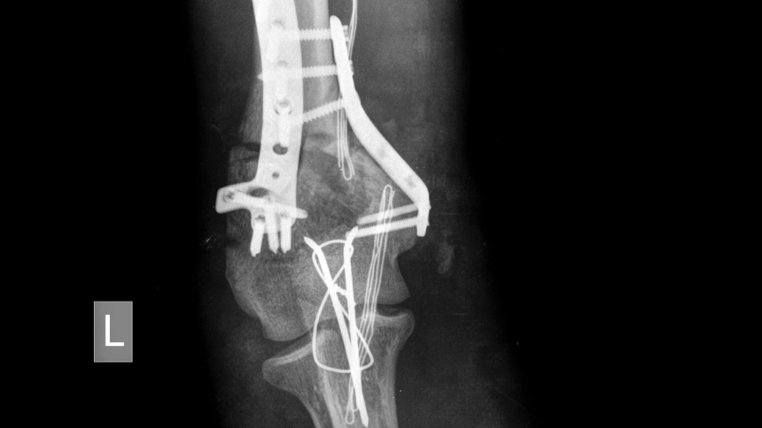 Komplikovaná zlomenina.