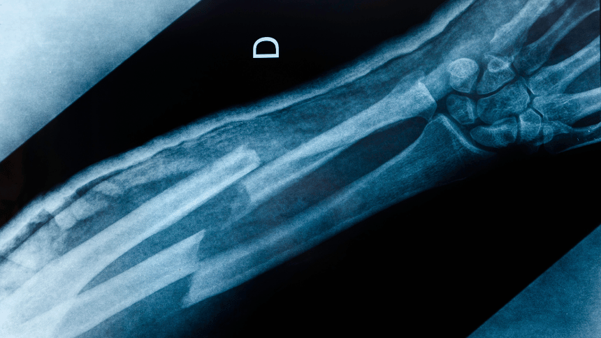 Zlomená ruka na rentgenu.