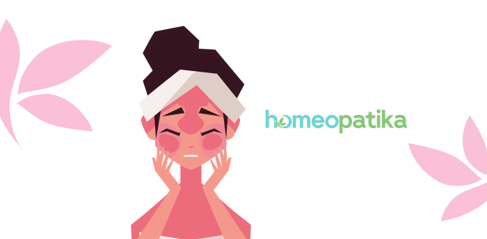  rosacea na obličeji