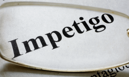 Slovo impetigo ve slovníku.