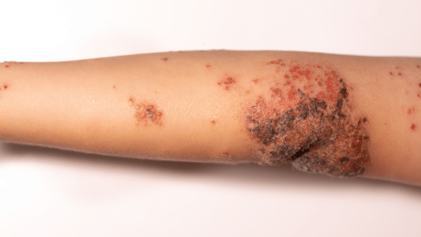 Bolestivé impetigo na ruce.