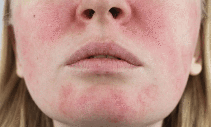 Rosacea na obličeji