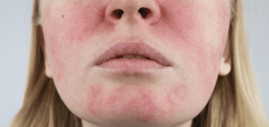 Rosacea na obličeji